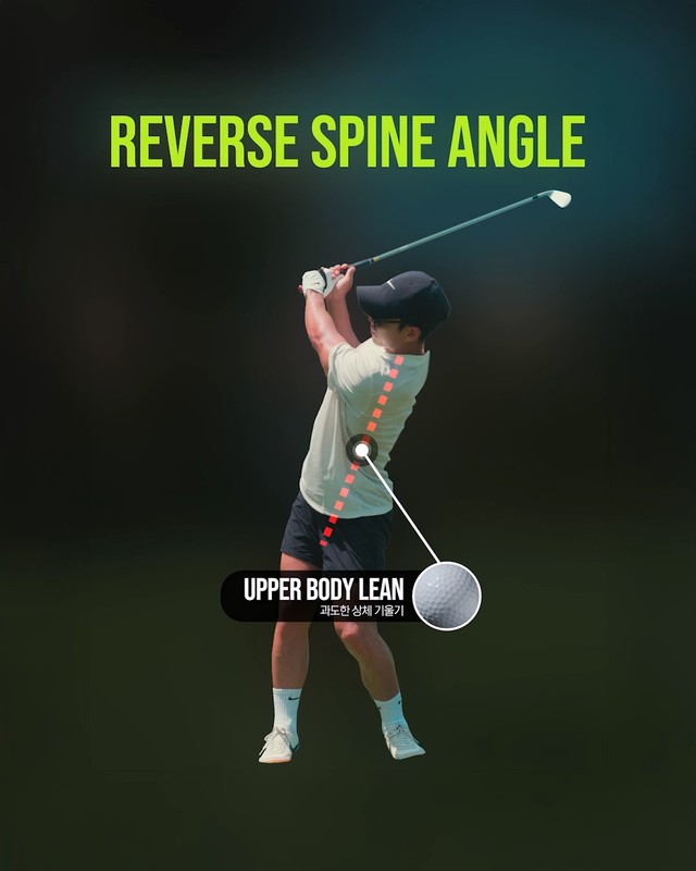Reverse Spine Angle