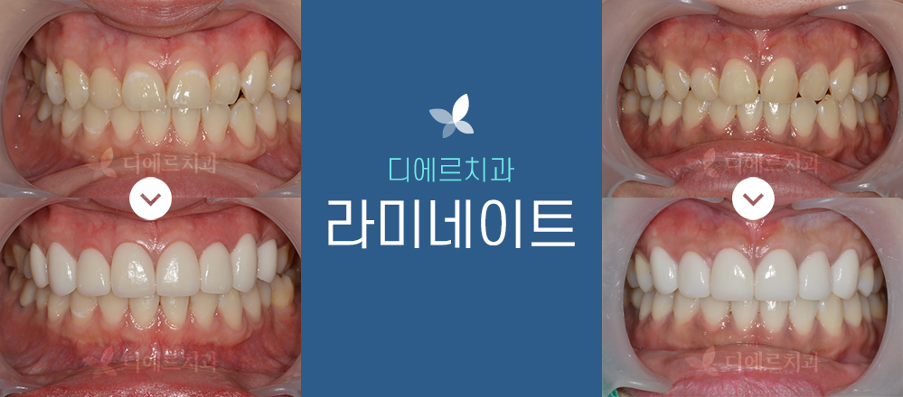 디에르치과 라미네이트