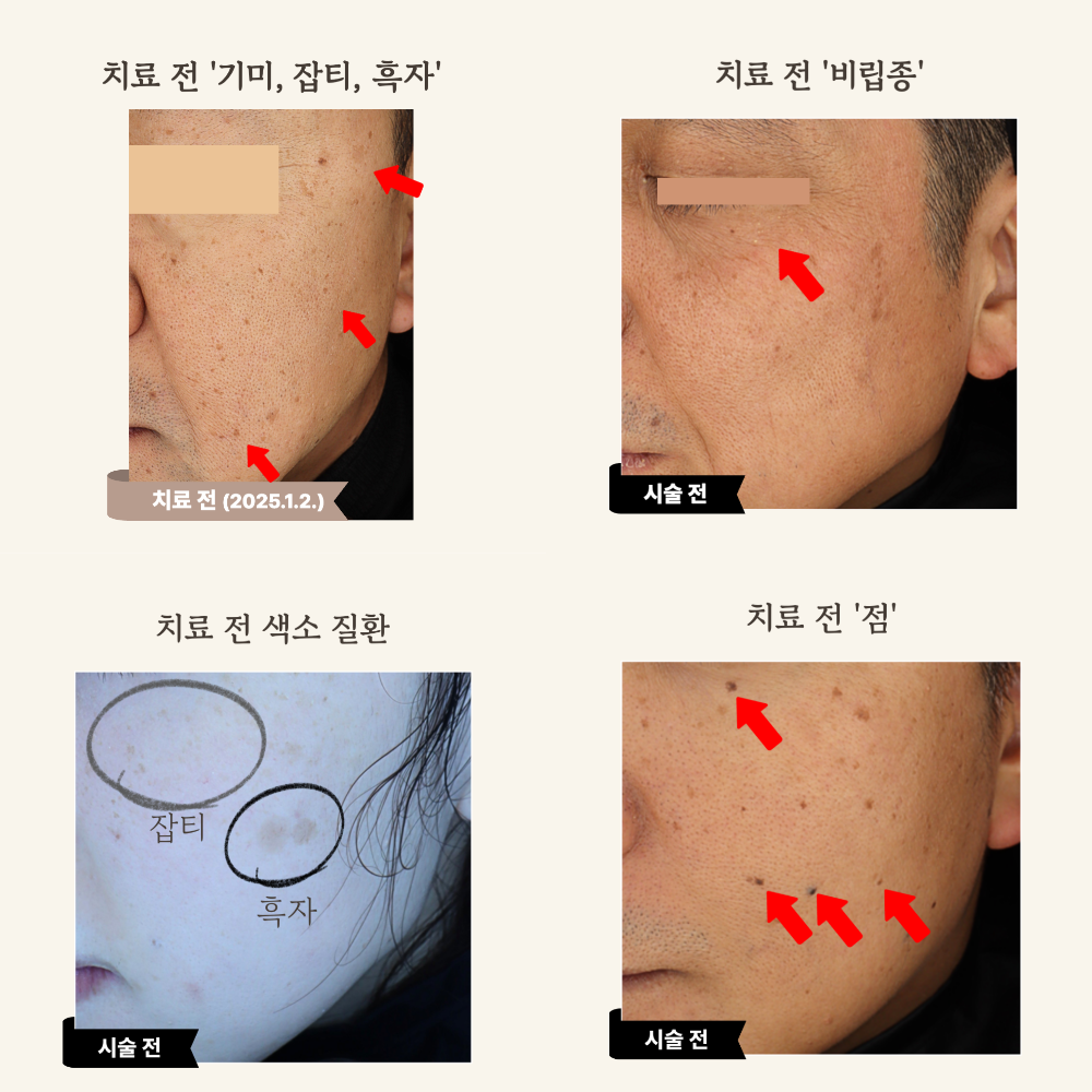 수원 얼굴한판ㅣ잡티, 흑자, 점, 비립종, 주근깨, 사마귀, 편평사마귀, 검버섯