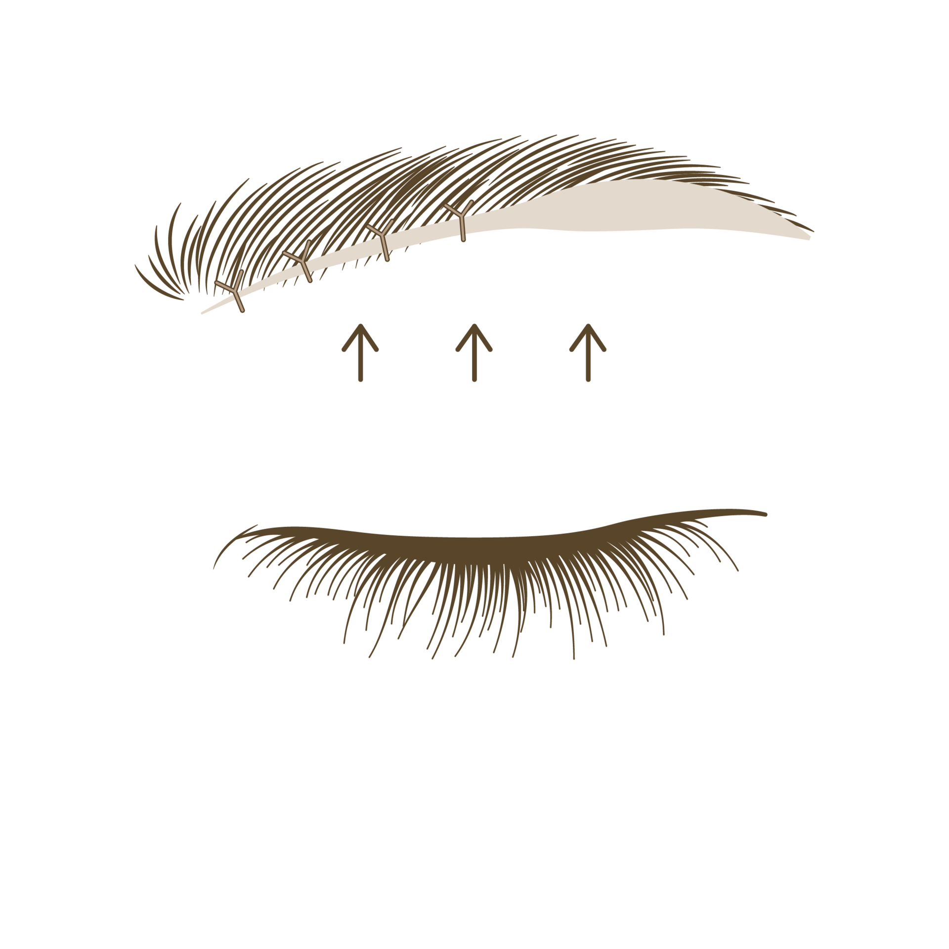 <p style="text-align: center;"><span style="font-size: 14px;">피부를 당겨서 봉합</span></p>