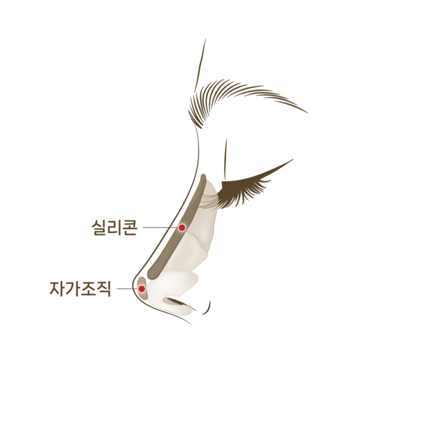 자가연골과 보형물을 삽입<br>