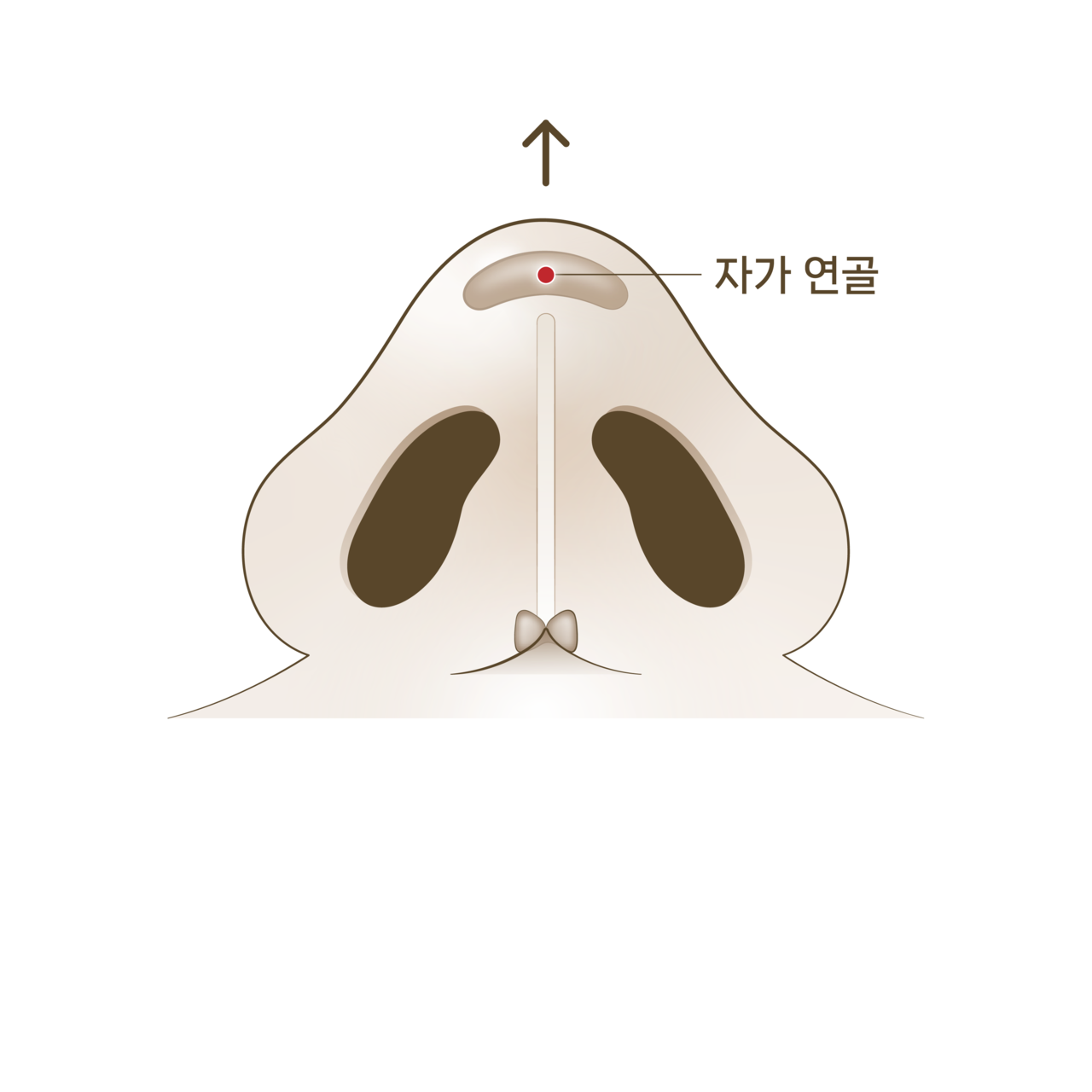 자가 연골로 코끝 높이기<br>
