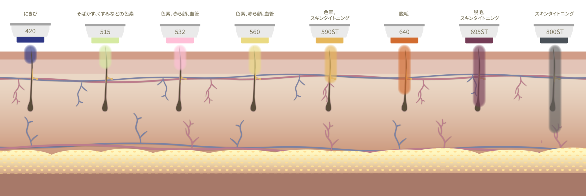 オーダーメイド型BBL スマートフィルター