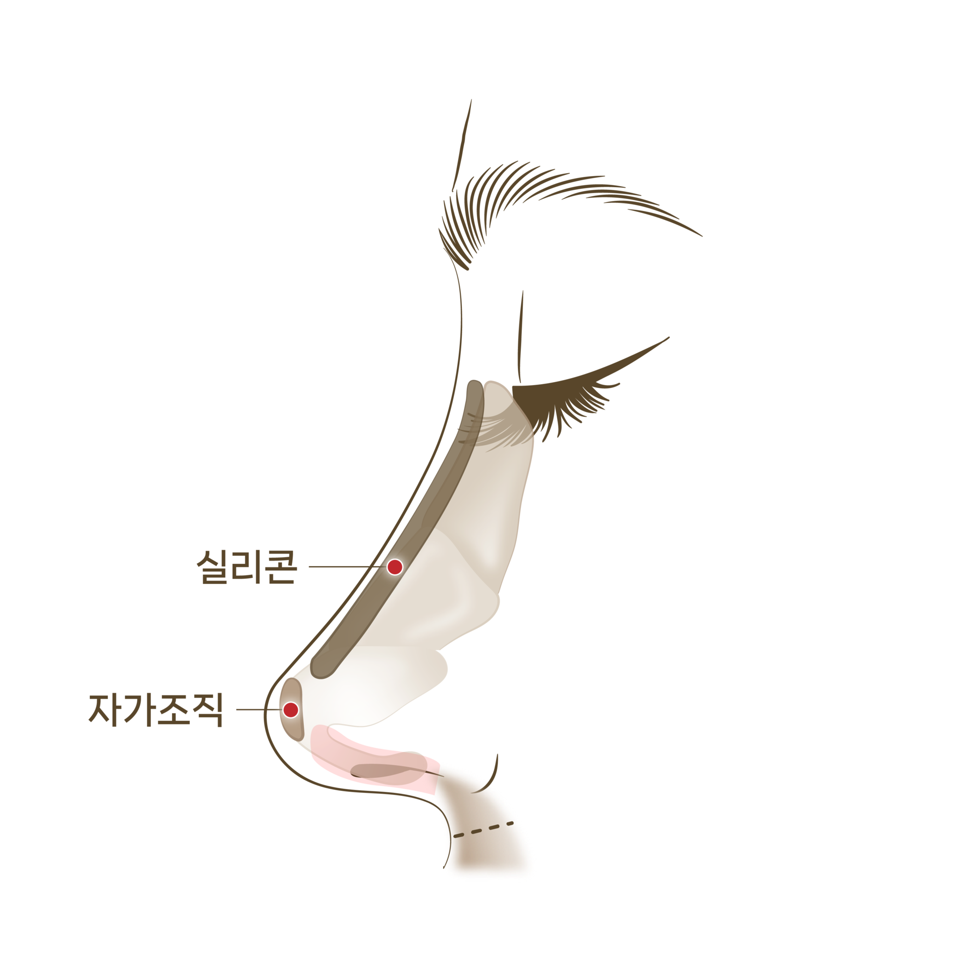 <p style="text-align: center;"><span style="font-size: 14px;">실리콘이나 자가조직 삽입</span></p>