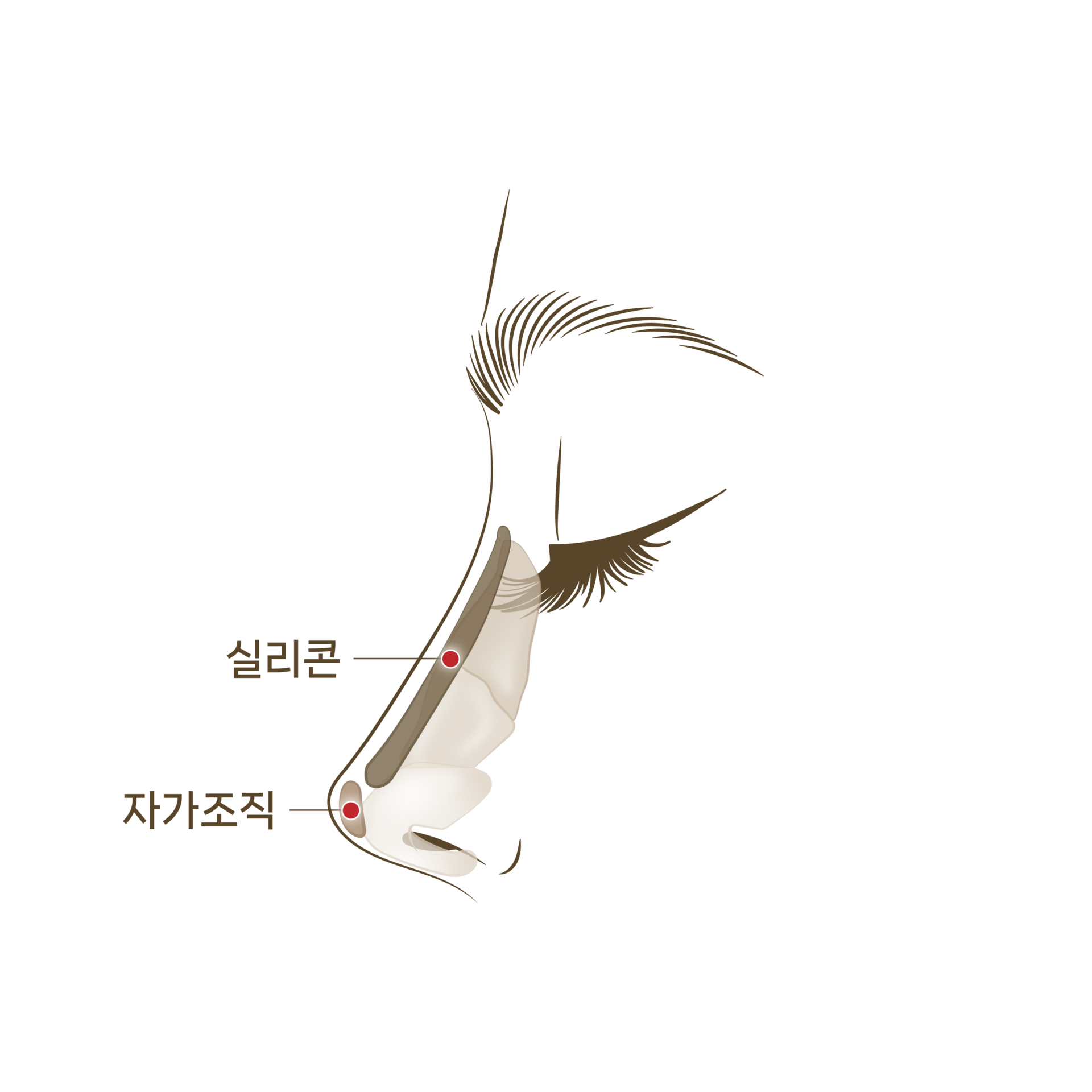 <p style="text-align: center;"><span style="font-size: 14px;">자가연골과 보형물을 삽입</span></p>