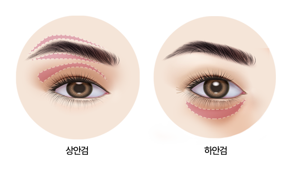 상안검, 하안검