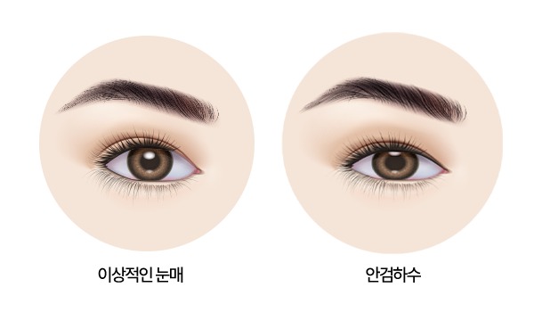 안검하수와 이상적인 눈매