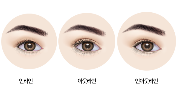 인라인, 아웃라인, 인아웃라인별 쌍커풀 시술