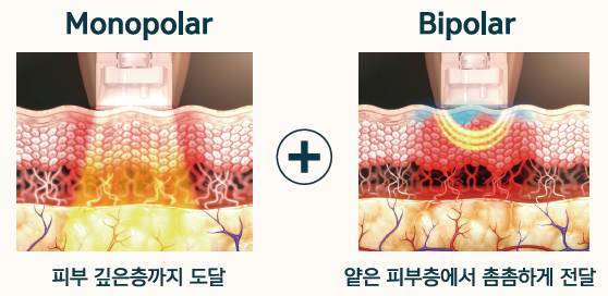 덴서티 리프팅의 모노폴라, 바이폴라 고주파를 보여주는 예시 이미지입니다.
