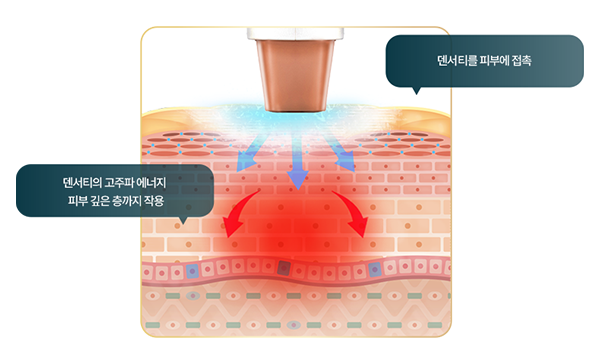 덴서티가 어떻게 피부에 접촉하여 고주파 에너지를 작용시키는지 보여줍니다.