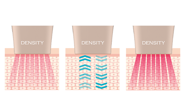 덴서티리프팅의 임피더스 피드백 시스템이 무엇인지 보여주는 이미지