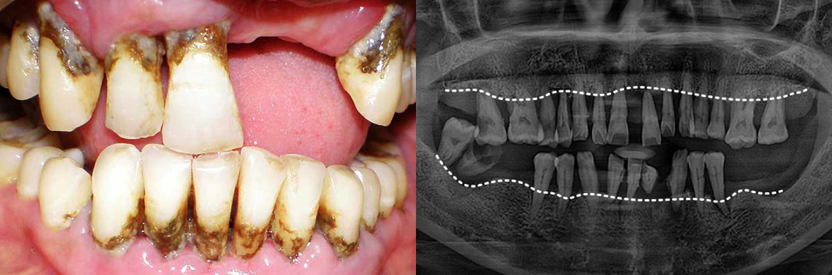 겉으로 보기에도 치석과 염증이 심하며, 잇몸이 심하게 붓고 내려앉아 있습니다.  엑스레이에서는 뿌리의 절반 이상이 드러날 정도로 잇몸뼈가 심각하게 소실되어 있습니다.