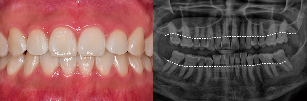 잇몸이 붉지 않고, 연분홍빛을 띠며 단단하게 치아를 감싸고 있습니다.  엑스레이에서는 치아 뿌리를 따라 잇몸뼈가 치아 경계선 바로 아래까지 촘촘하게 유지되고 있습니다.
