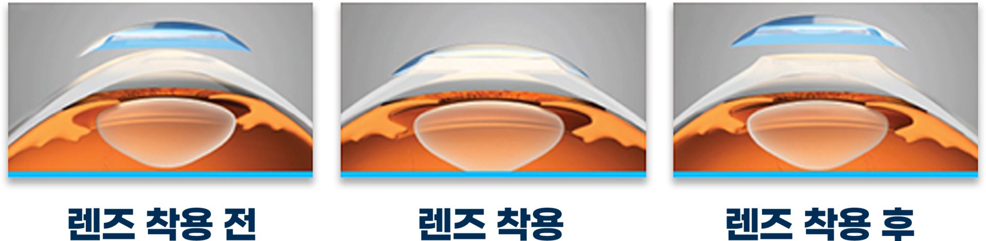 드림렌즈 착용법