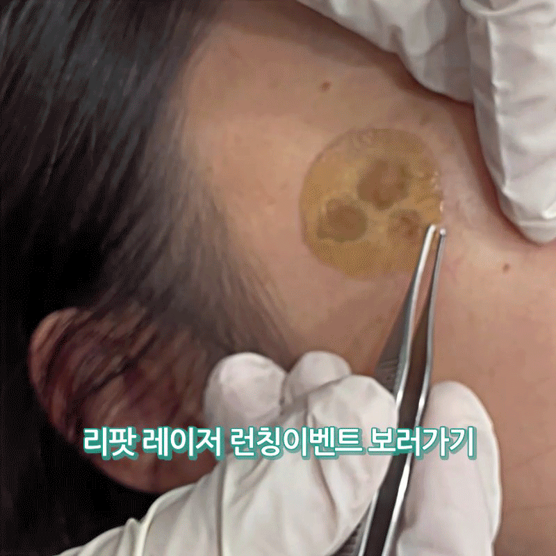 리팟레이저
