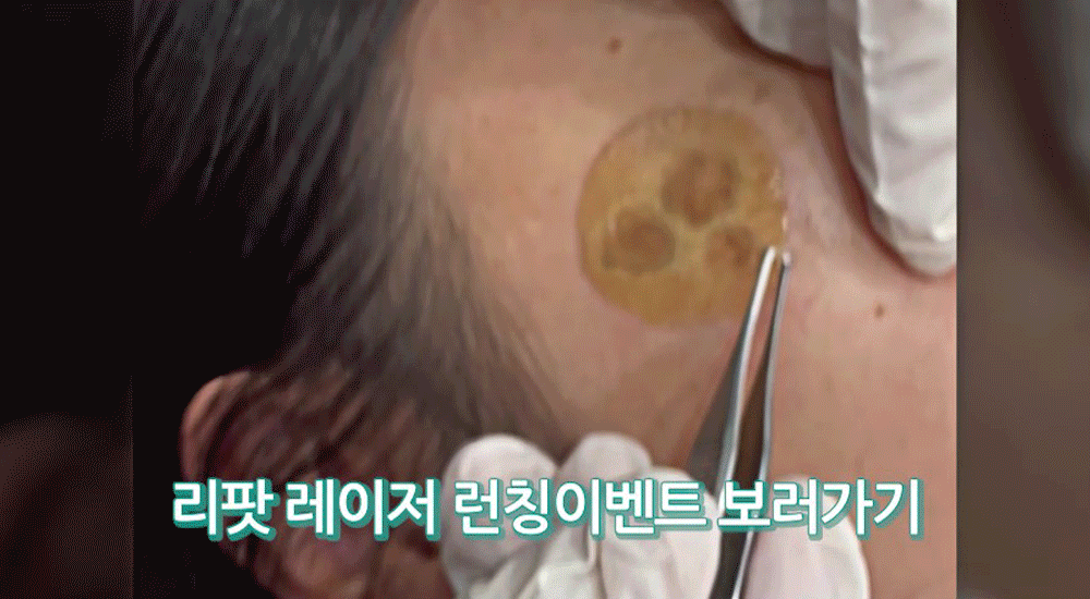 리팟레이저