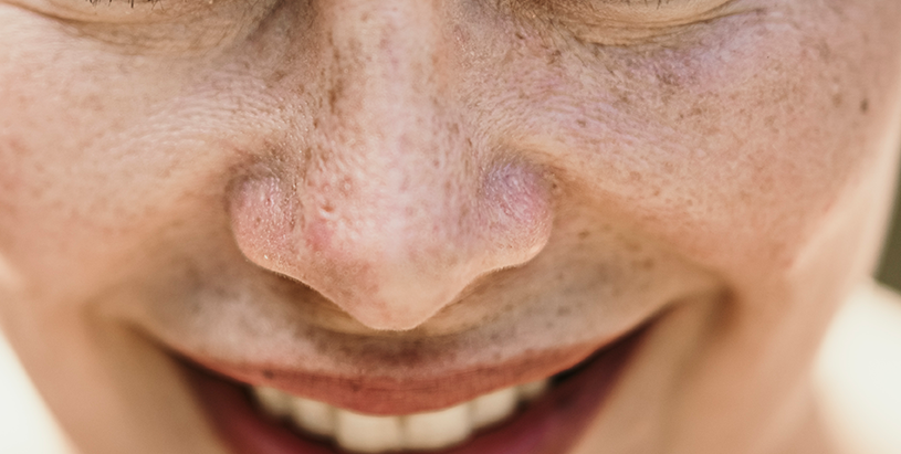 얼굴 중안부에 생긴 기미