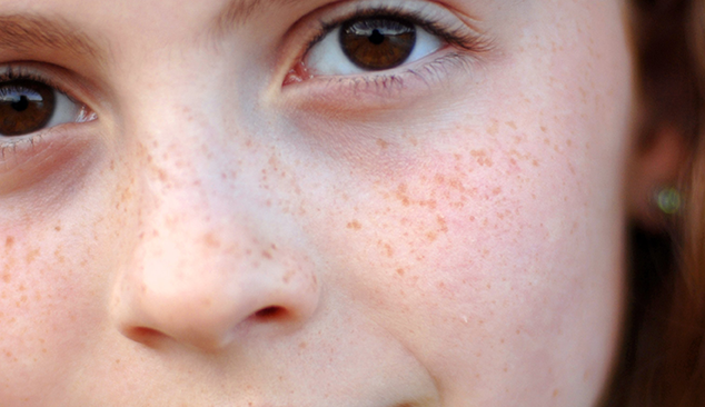 주근깨 예시 이미지