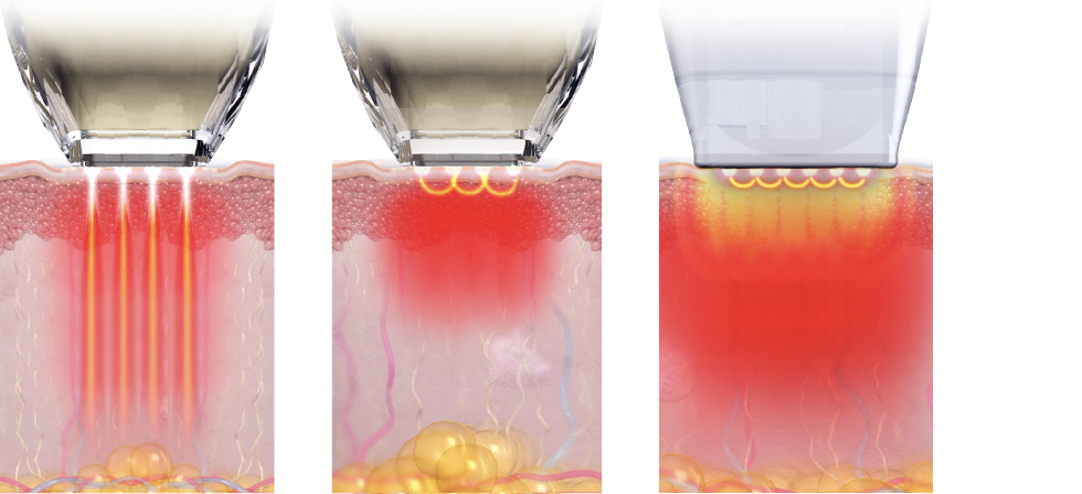 다양한 포텐자 팁 고주파양상