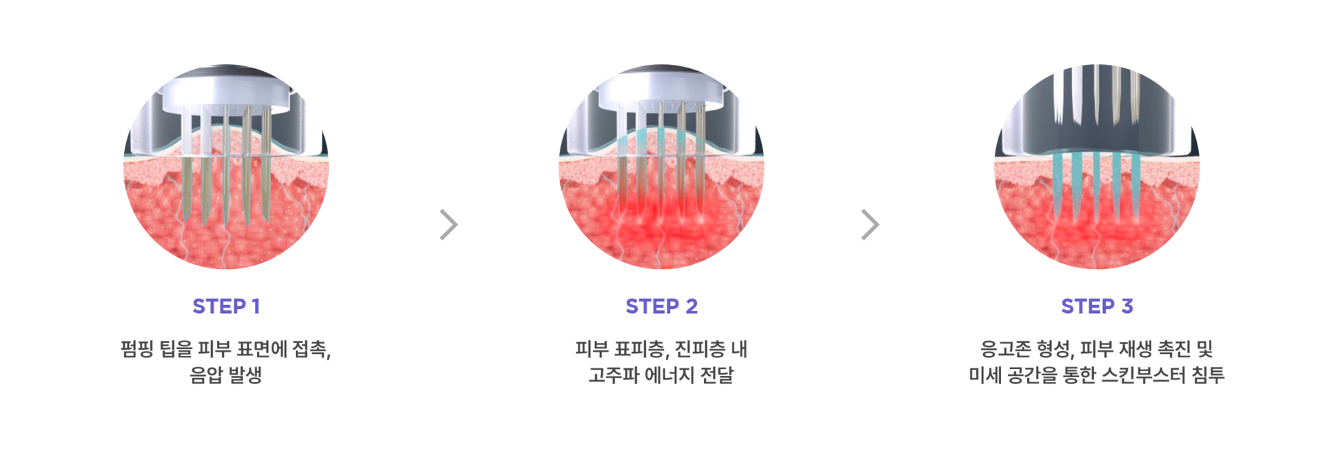 포텐자 펌핑팁 스킨부스터 시술원리