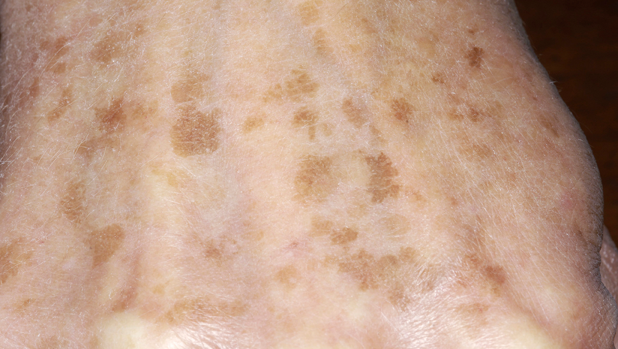 손등에 생긴 잡티