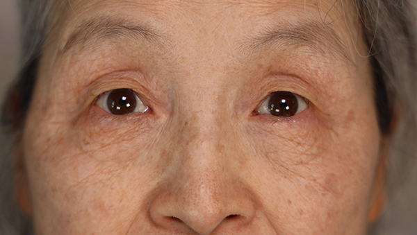 얼굴에 검버섯이 핀 노인의 얼굴