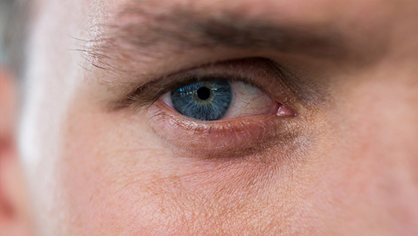 혈관형 다크서클 예시 사진