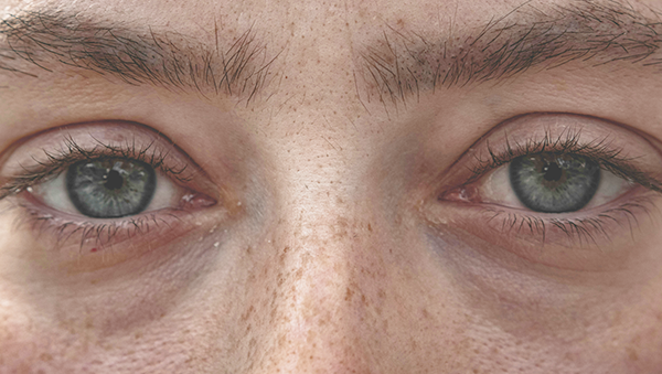 그늘형 다크서클 예시 사진