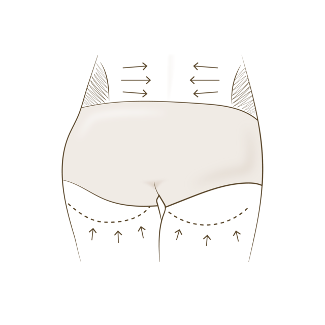 허벅지, 엉덩이, 복부 등에서 지방 채취 <br>