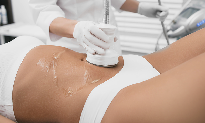 고주파 시술 중인 모습