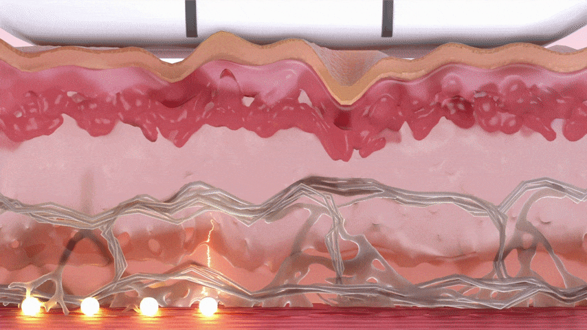 울쎄라 리프팅 시술 예시