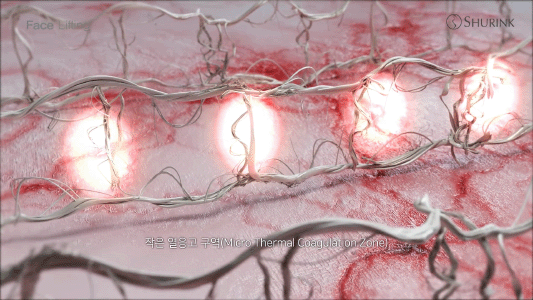 슈링크가 피부 세포에 어떤 영향을 미치는지 보여주는 이미지