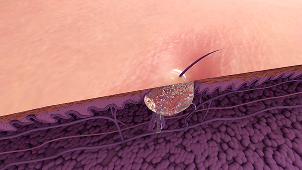 여드름을 클로즈업한 이미지