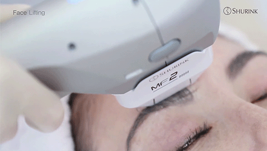 슈링크 리프팅 카트리지 클로즈업