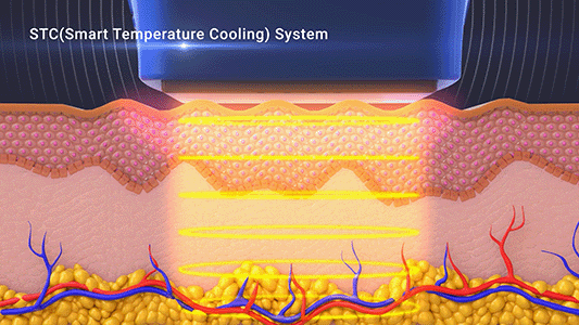 텐써마 모노폴라 RF