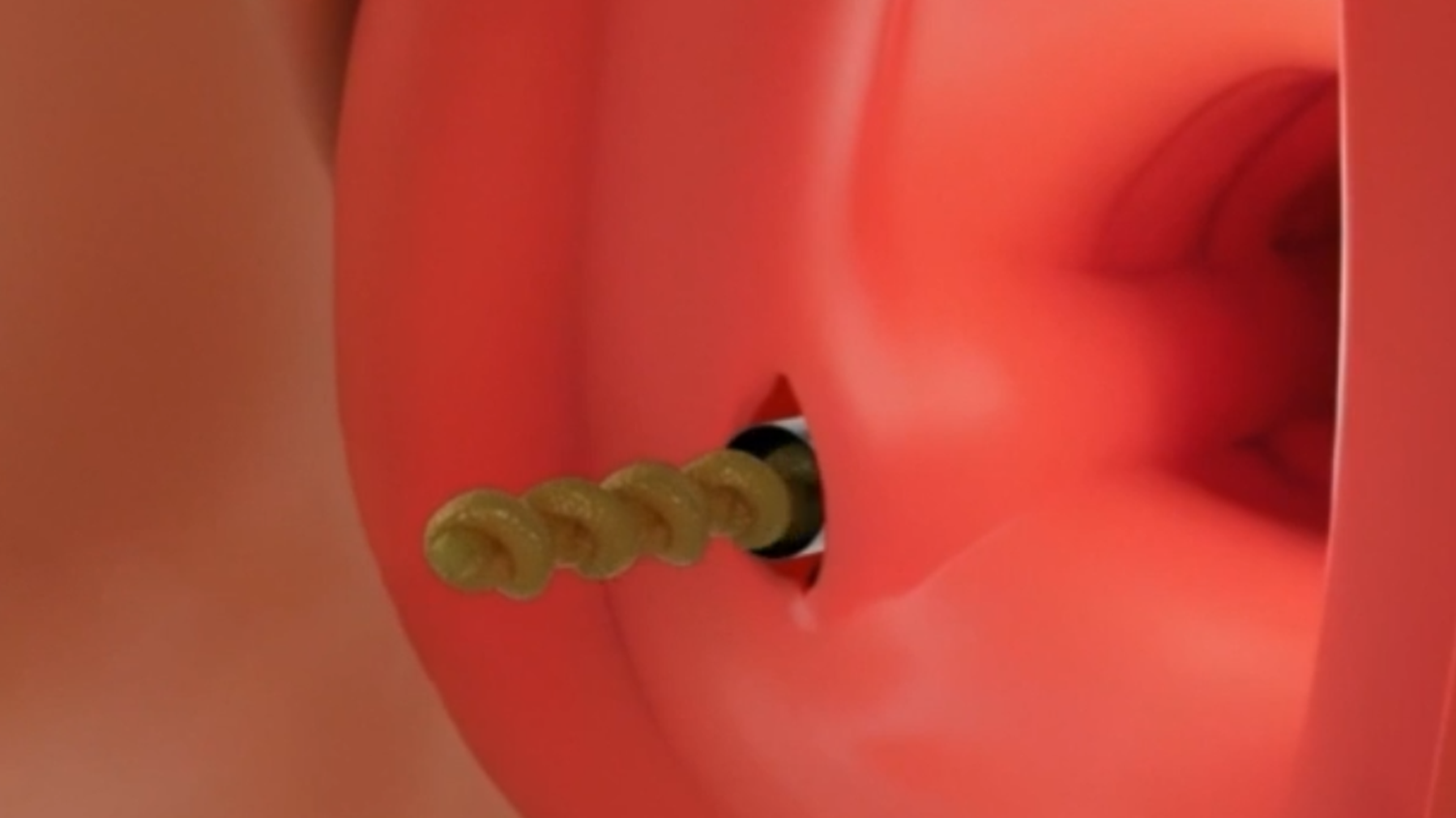 2) HD IMPLANT_F 삽입