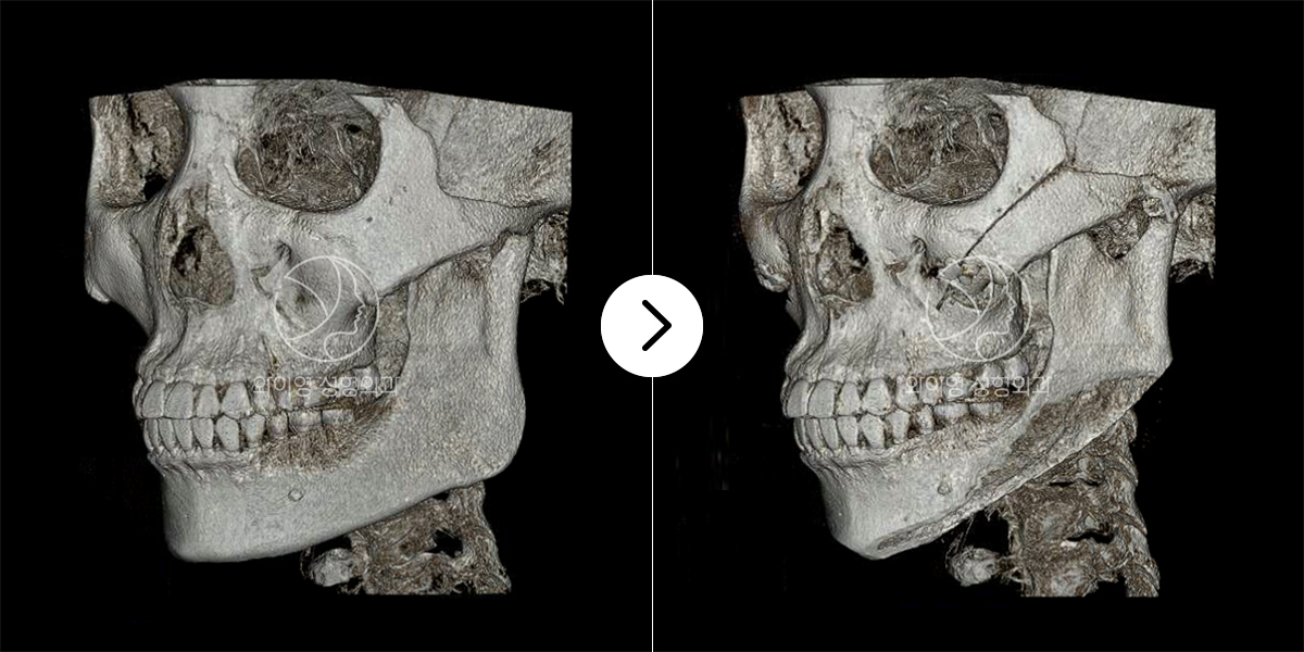 3D-CT로 수술 전후확인