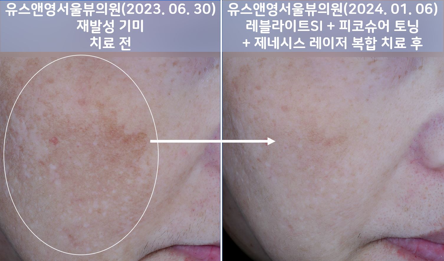 세종피부과 유스앤영서울뷰의원 기미/잡티/색소 전후사진 ㅣ 자연스러운 개선과 건강한 피부 톤