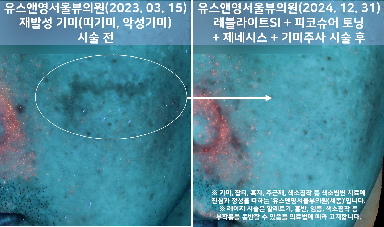 세종피부과 유스앤영서울뷰의원 기미/잡티/색소 전후사진 ㅣ 자연스러운 개선과 건강한 피부 톤
