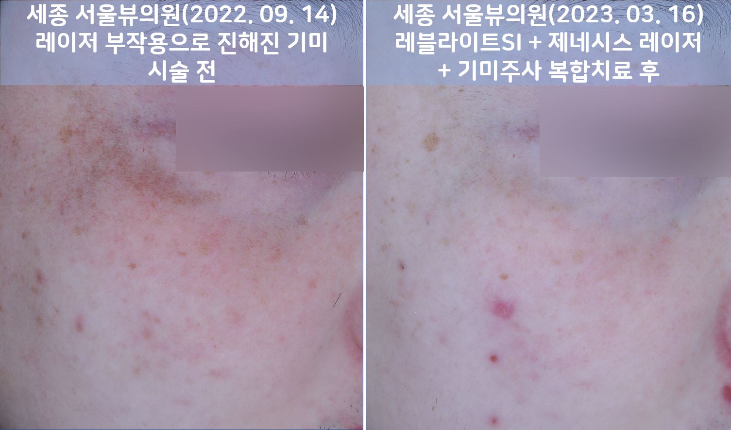 세종피부과 유스앤영서울뷰의원 기미/잡티/색소 전후사진 ㅣ 자연스러운 개선과 건강한 피부 톤