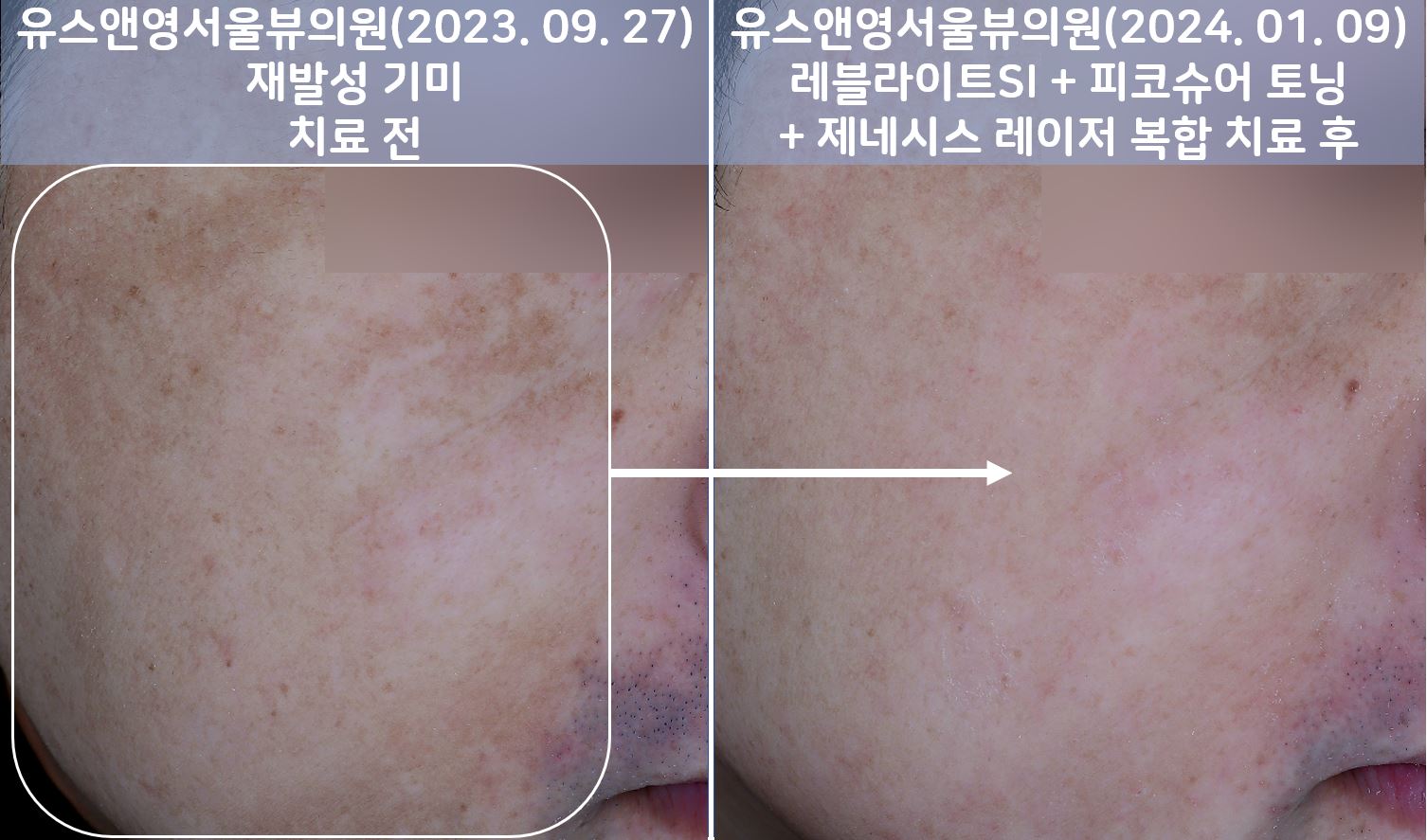 세종피부과 유스앤영서울뷰의원 기미/잡티/색소 전후사진 ㅣ 자연스러운 개선과 건강한 피부 톤