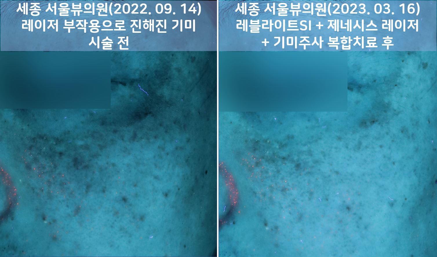 세종피부과 유스앤영서울뷰의원 기미/잡티/색소 전후사진 ㅣ 자연스러운 개선과 건강한 피부 톤