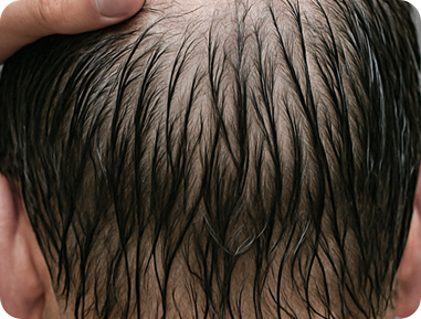 <p style="text-align: center;"> 	<br> </p>  <p style="text-align: center;"><span style="font-size: 24px; color: rgb(255, 255, 255);">擔心流汗或下雨時</span></p>  <p style="text-align: center;"><span style="font-size: 24px; color: rgb(255, 255, 255);">看起來頭髮更稀疏</span></p>  <p style="text-align: center;"> 	<br> </p>