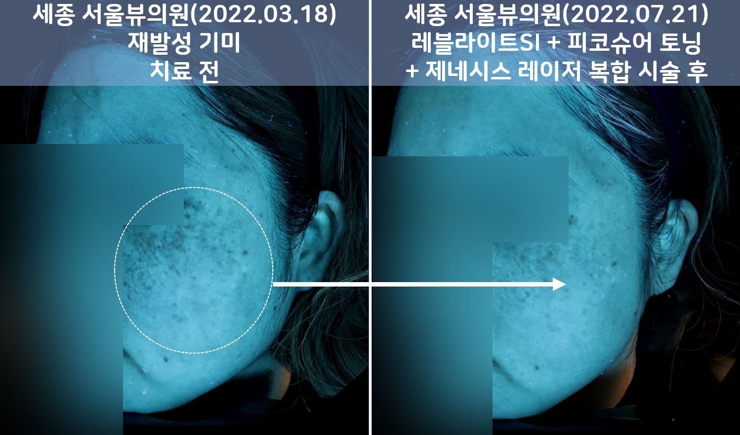 세종피부과 유스앤영서울뷰의원 기미/잡티/색소 전후사진 ㅣ 자연스러운 개선과 건강한 피부 톤