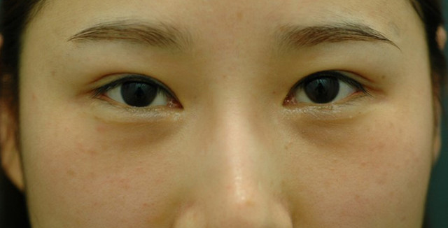 돌출이 심하지 않지만 눈에 거슬리는 20대