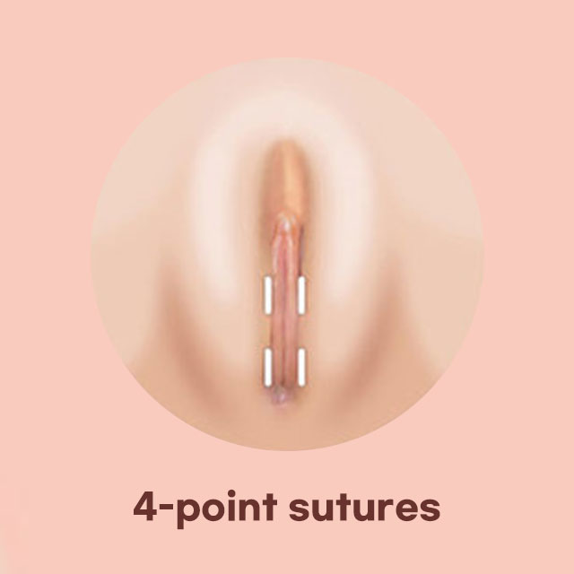To tuck the labia minora wings inside the labia majora, we create folds using the 4-point suture technique