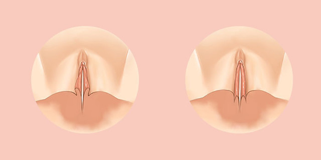 The shape of the labia minora can also  be designed, with the surgical procedure designed with precision.