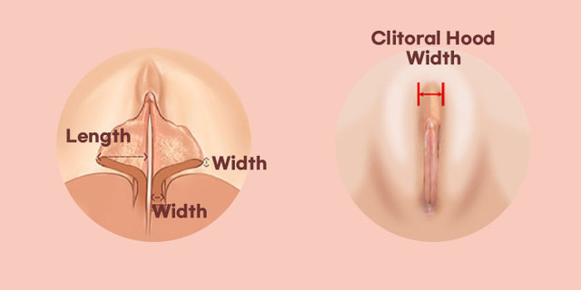 The shape, thickness, and width  of the labia minora vary. Surgical procedures tailored to each specific condition