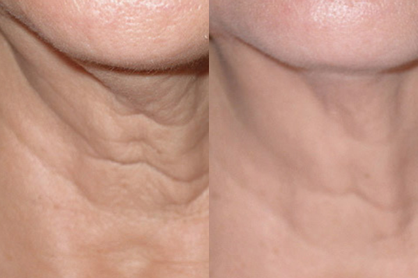 <p><span style="font-size: 12px;">BEFORE → AFTER</span> </p>