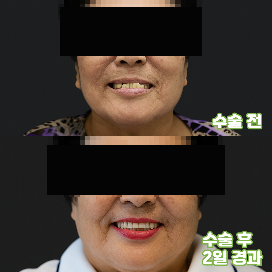 수술 전 / 수술 후 2일 경과, 70대 여성 (2024/09 촬영)